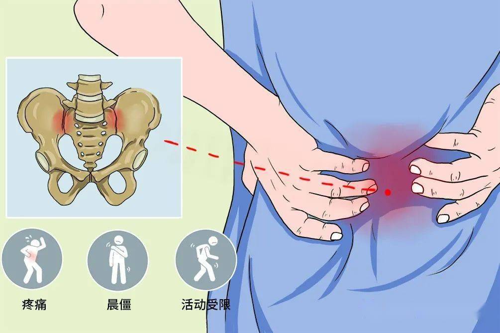 骶髂关节炎怎么办图片