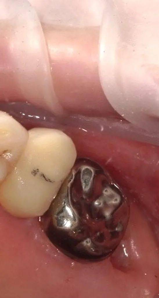 关于金属恒牙预成冠应用的思考—牙隐裂的金属预成冠临时修复