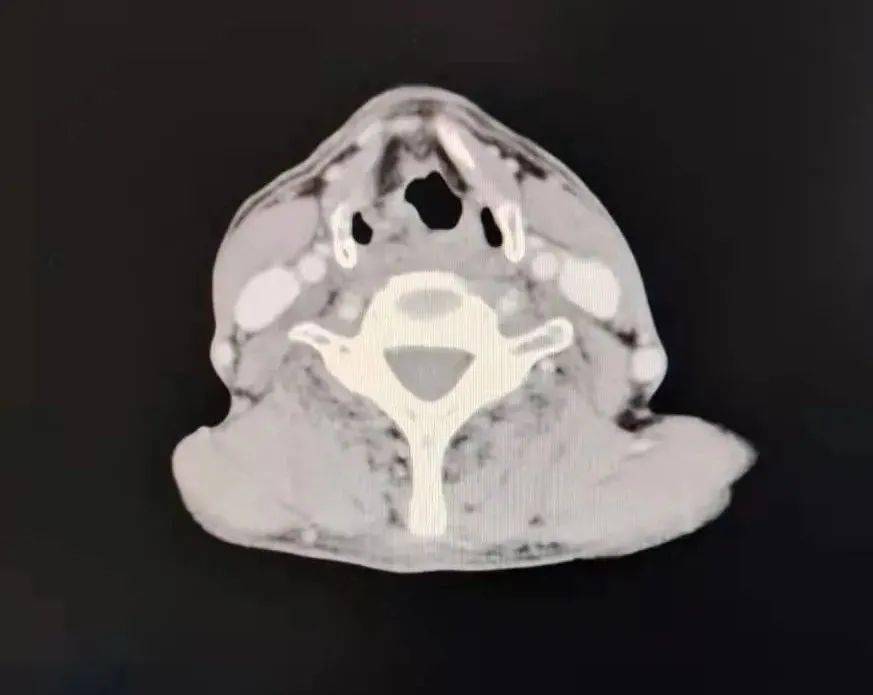 围观晚期喉癌我还能吃饭说话吗