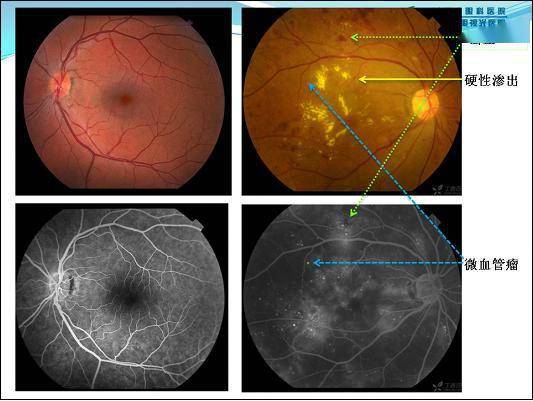 如何理解眼底照片_血管_視網膜_視盤