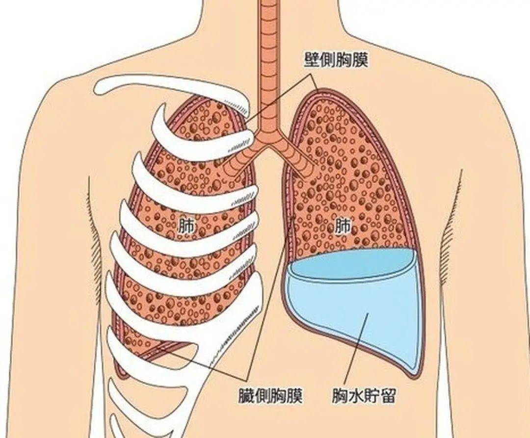 導致胸水常見的原因有炎症,肺結核,腫瘤以及心肝腎功能不全,而一些