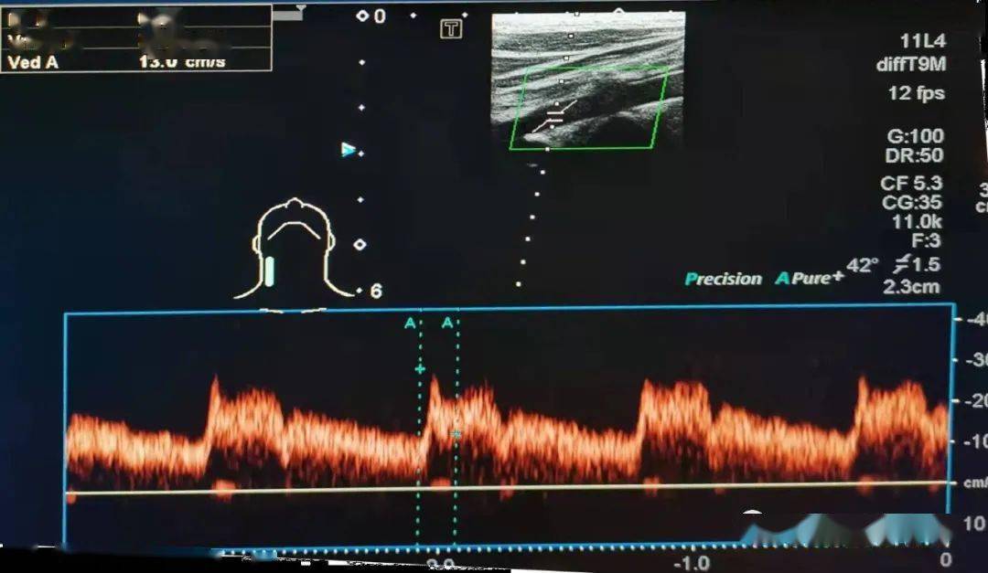 血管超声问答61这个椎动脉双向频谱是部分窃血吗