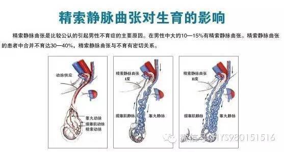 精索静脉曲张的原因早期症状及手术治疗