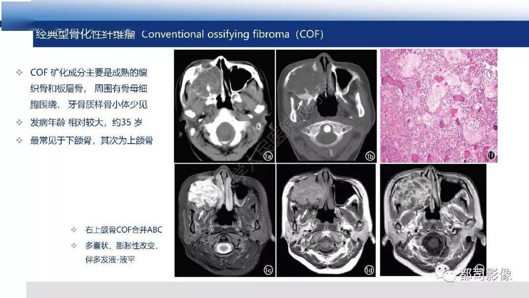 顱底沙瘤樣骨化纖維瘤影像診斷_全網_解剖圖_系統