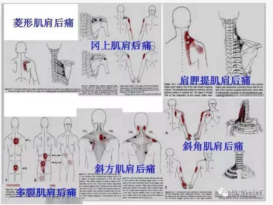 肌筋膜全身160个疼痛触发点