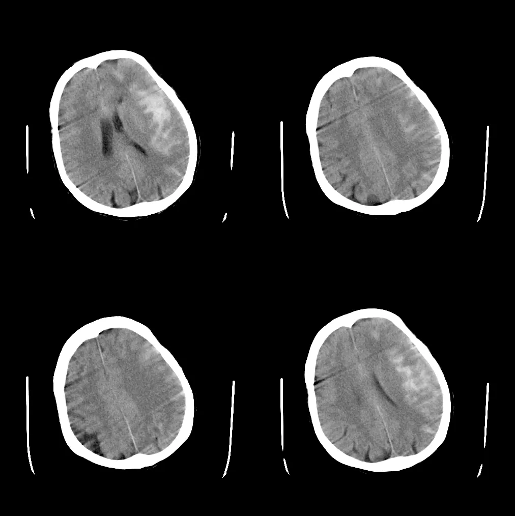 裂池(以左侧为主)高密度,大脑纵裂池密及左侧额顶部部分脑沟密度增高