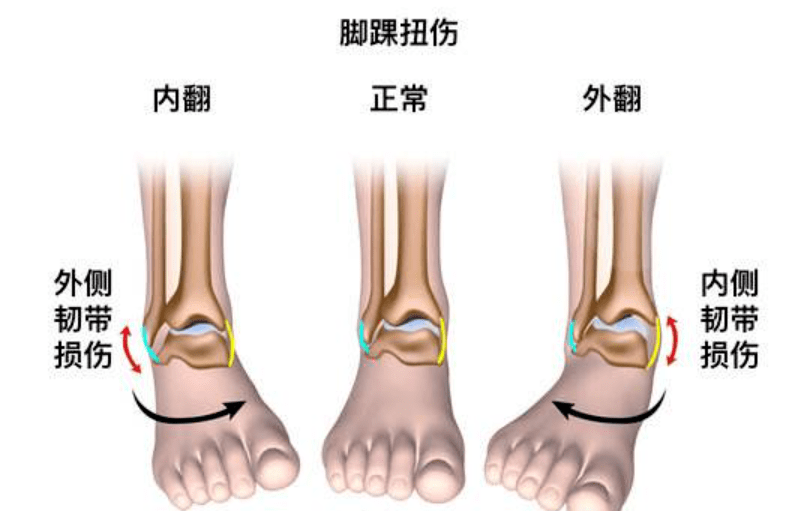 脚背朝外的脚踝内翻,加上由上而下的压力,会造成脚踝前外侧的韧带伤