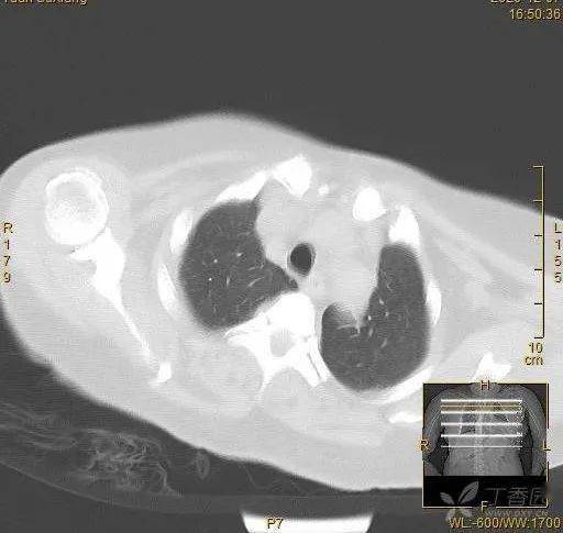 66歲老人靜脈輸注營養液突發呼吸困難竟抽出粉紅色胸水