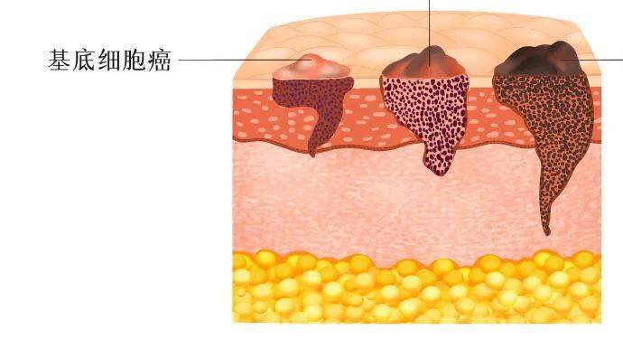 長在鼻翼邊緣的痣竟是基底細胞癌