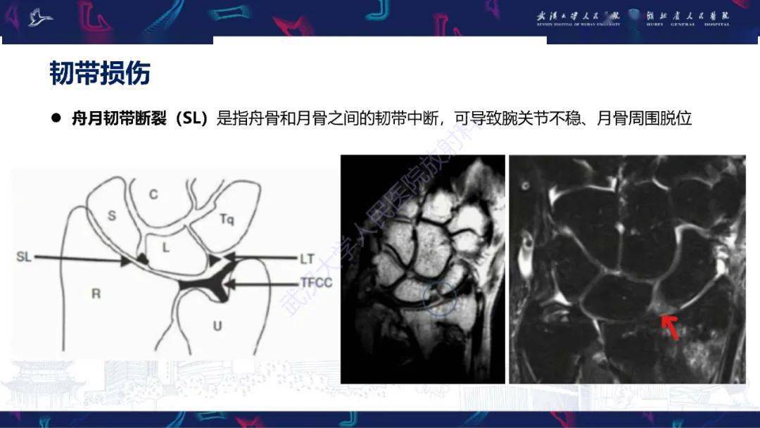 拇长屈肌腱解剖图mri图片