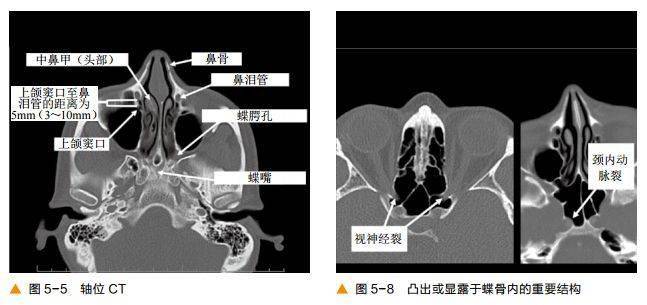 颅底及鼻窦ct轴冠矢解剖
