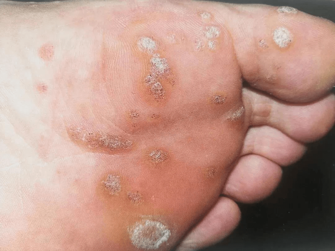 【一科一品】渭南市第二医院医学美容中心之寻常疣诊疗_诊断_典型