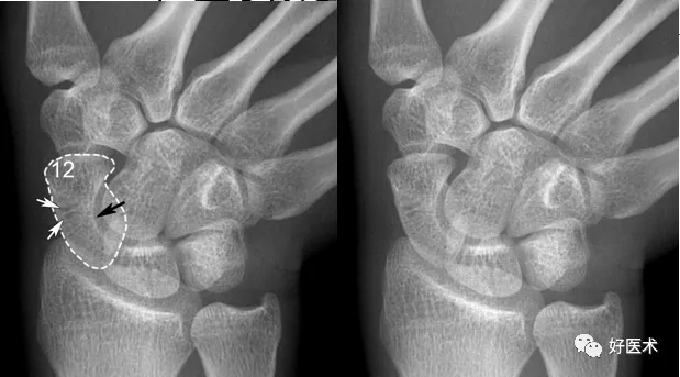 赞腕关节x线高清解剖腕骨脱位典型病例