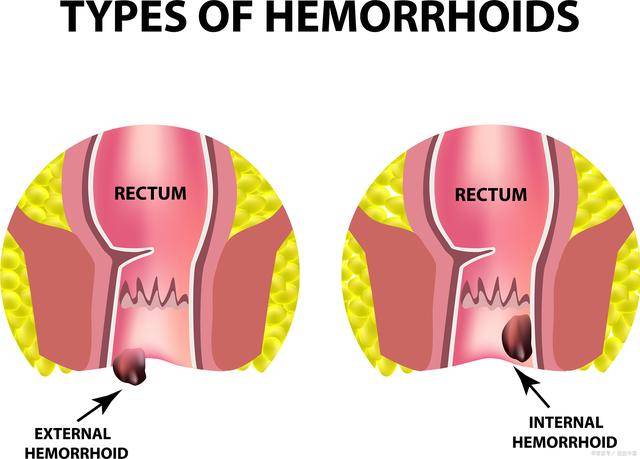 痔疮外痔肉球怎么消除?用什么药膏可以消掉肉球