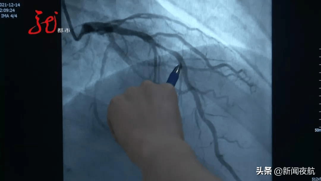 胸痛|血管“断”了，36岁医生倒下！这类人群要警惕