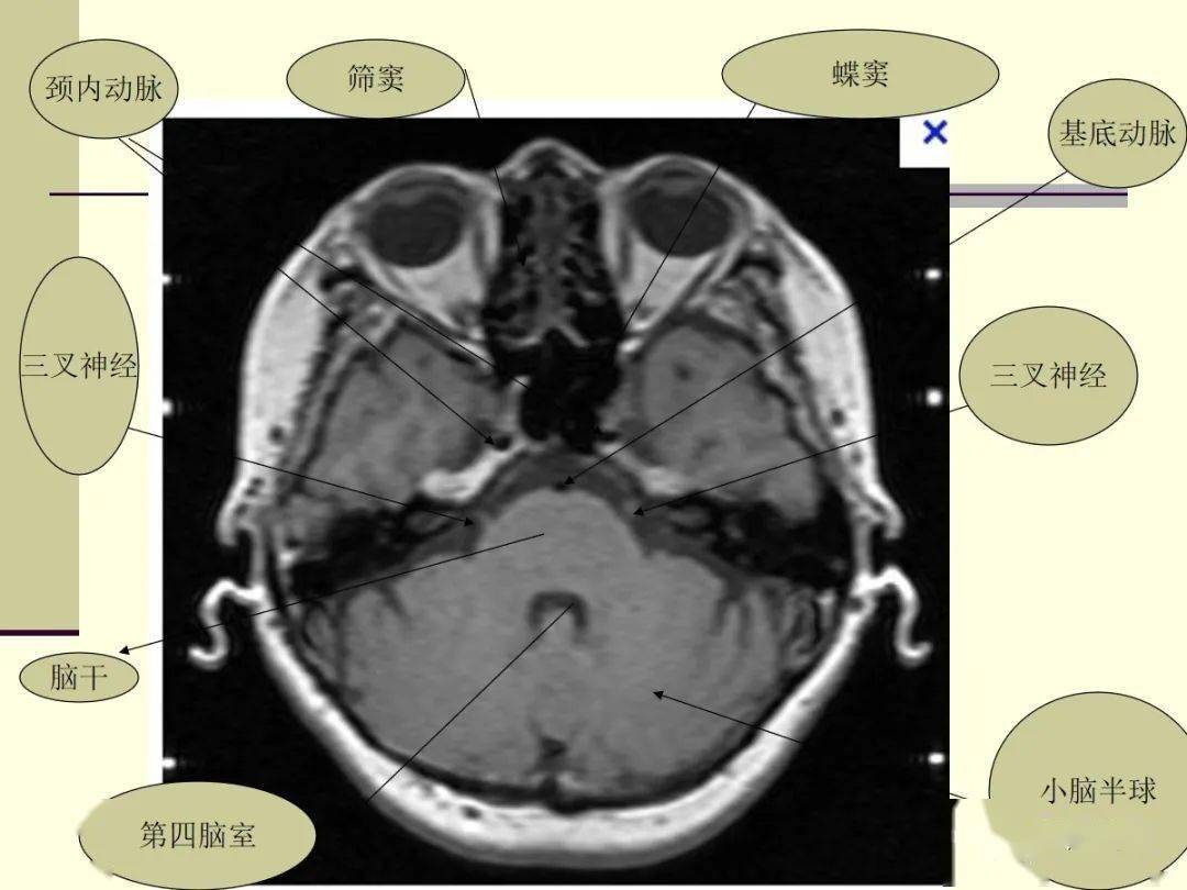 三叉神经解剖及常见疾病mr表现