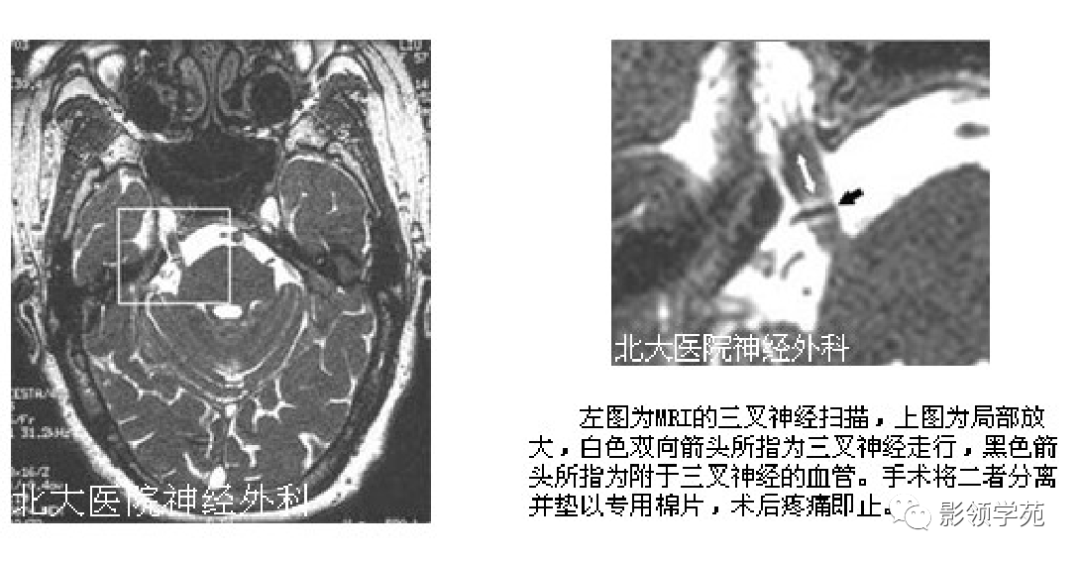 三叉神經解剖及常見疾病mr表現