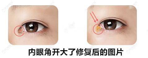 内眼角开大了可以回包眼角来缩小吗