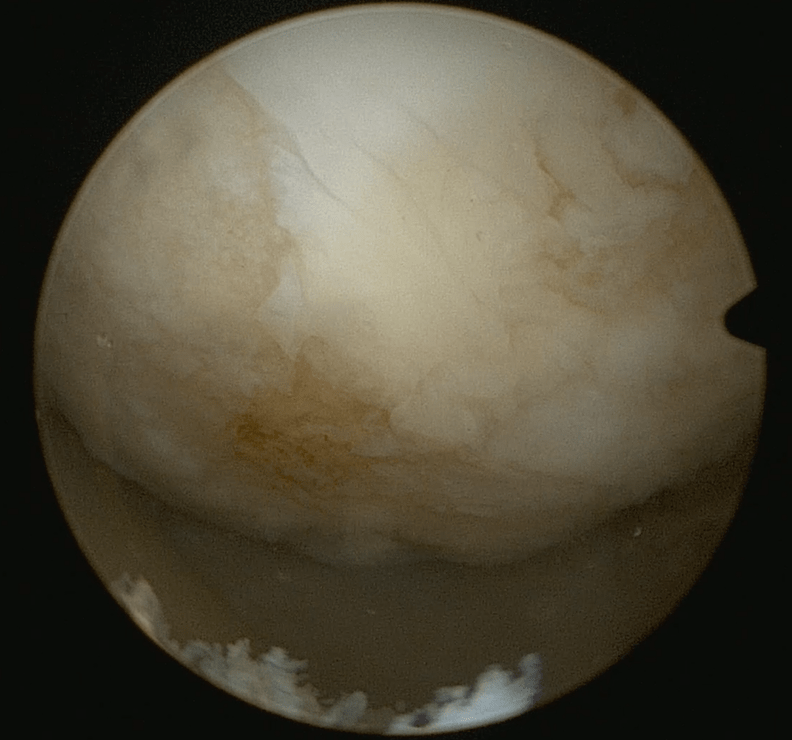 李劼|老寒腿变天就现梅花点，保守治疗或将加重病情