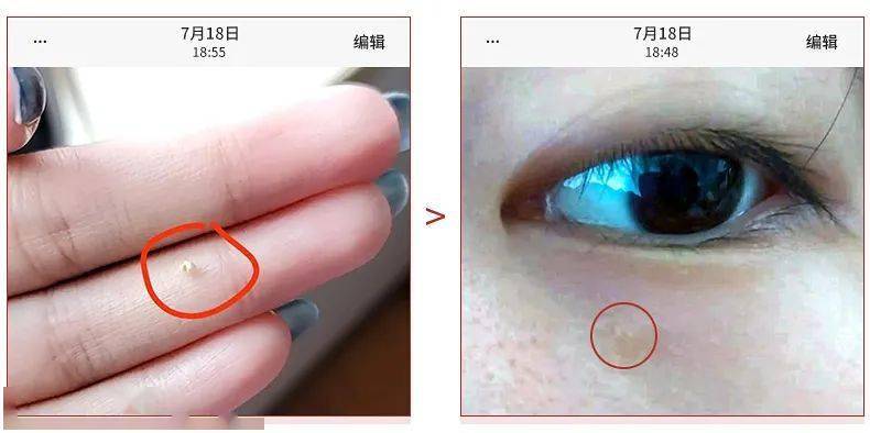 眼睛别再用针挑了！用它，脂肪粒自己“掉”下来，比医美效果还赞！