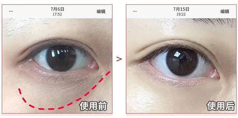 眼睛别再用针挑了！用它，脂肪粒自己“掉”下来，比医美效果还赞！