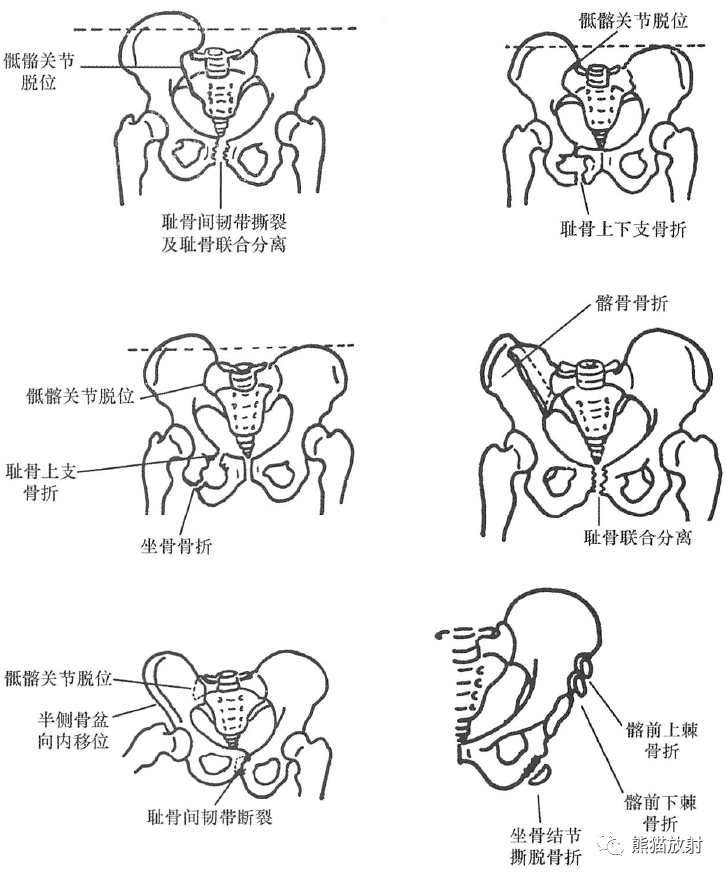 股骨粗隆下骨折分型图片