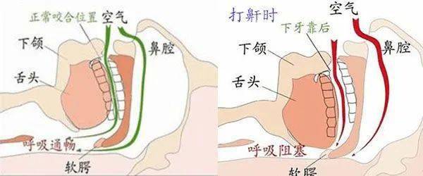 打鼾的发生机制:part one 流行病学不