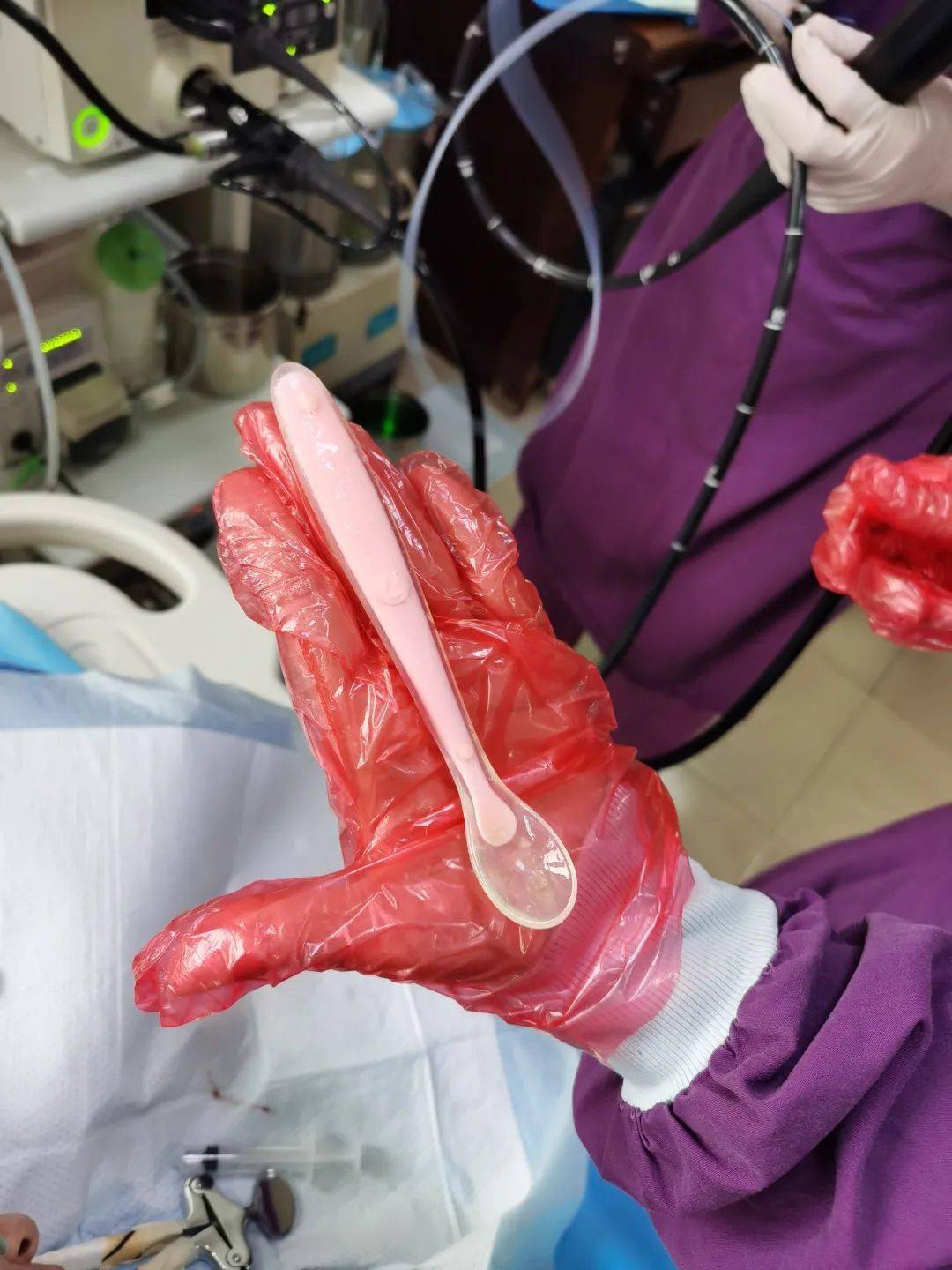 感觉|女子感觉咽喉有异物用勺子抠喉 不慎把勺子吞了下去