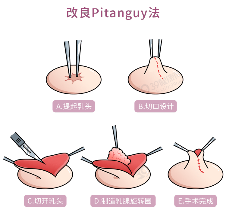 乳头内陷手术对比图片