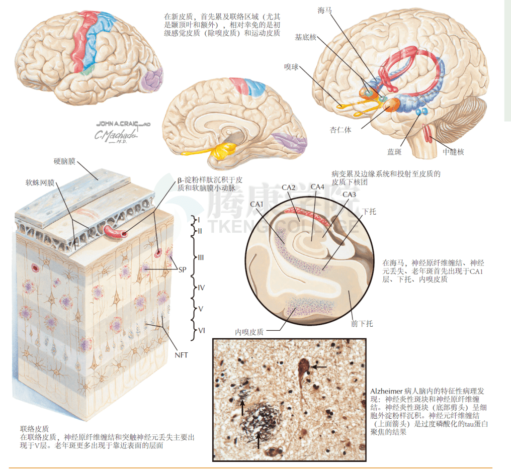 神经解剖学阿尔兹海默症脑部病变分布