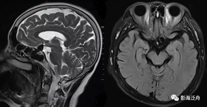 诊断|颅脑MR平扫中极易漏诊的点