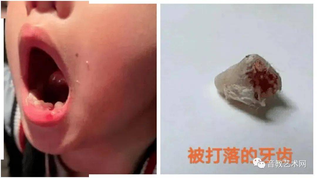 6岁男孩被钢琴老师扇掉牙找错老师真的会毁掉一个孩子