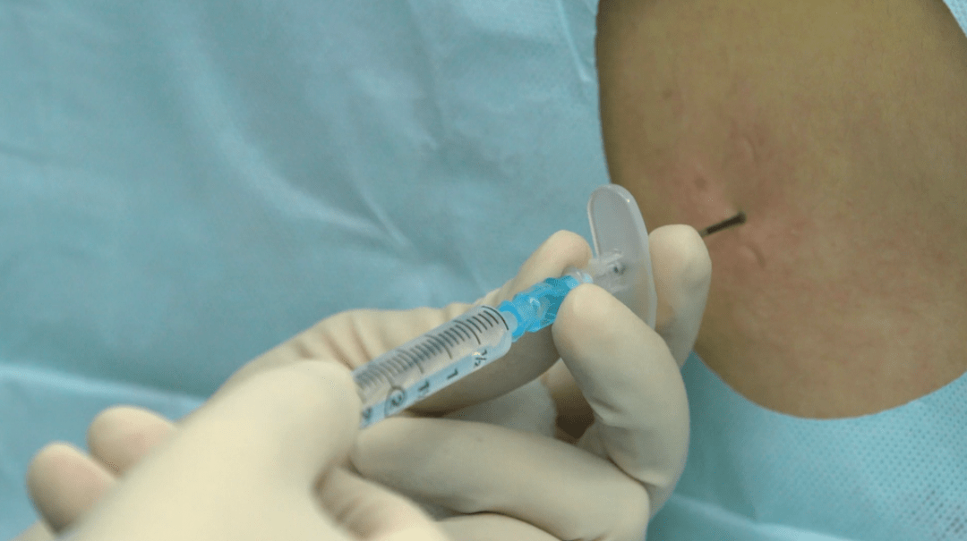 局部浸润麻醉使用1%利多卡因.