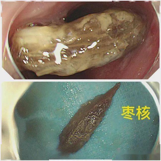 异物_食管_李先生