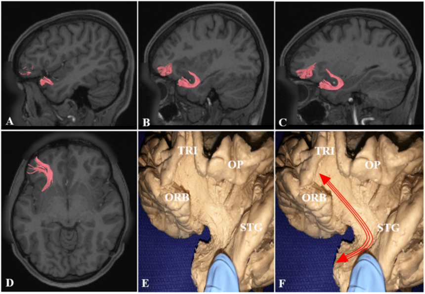 mri-t1加權成像顯示內側和外側矢狀面以及軸向平面得鉤突束的纖維束