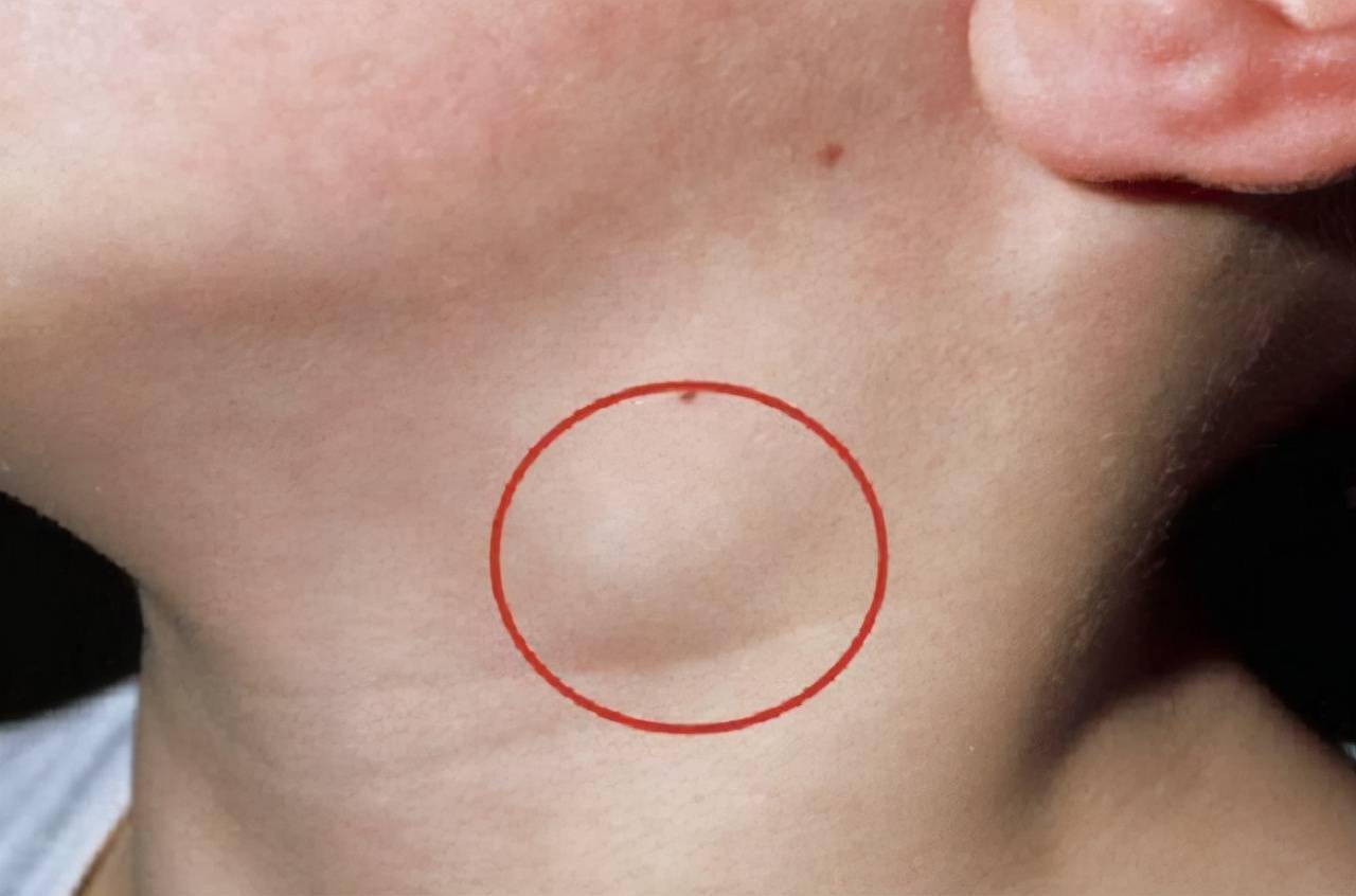 受到疾病的入侵淋巴结会异常肿大,脖子部位的淋巴分布广泛,受到影响