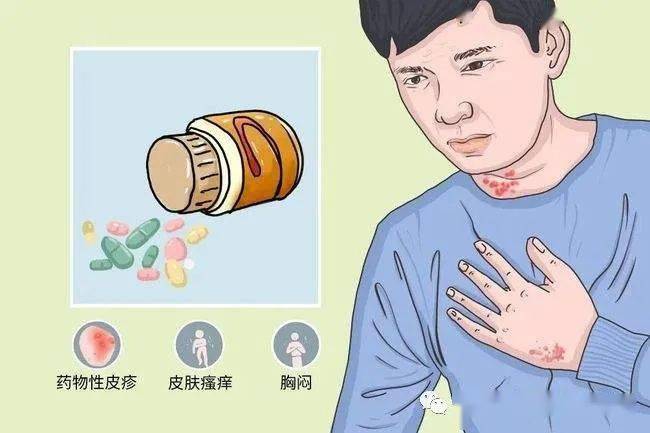 有药物过敏史会影响招飞体检合格吗?_休克_人群_严重