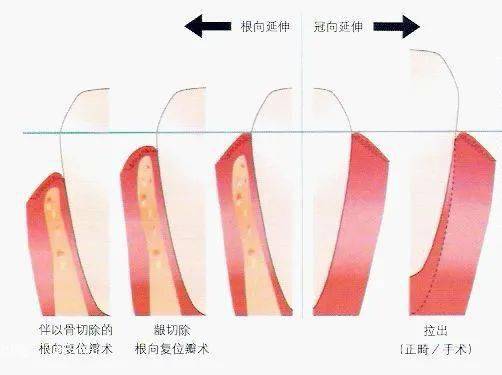 牙龈与修复体边缘关系图解