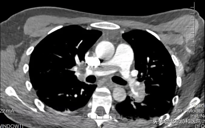 团队|协和京藏携手 千里生命接力 | 一例急性大面积肺栓塞患者被成功救治
