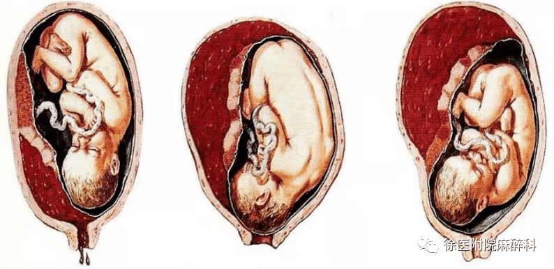 病例分享 | 一例与胎盘早剥相关的凝血功能异常病例报告_麻醉_mmhg