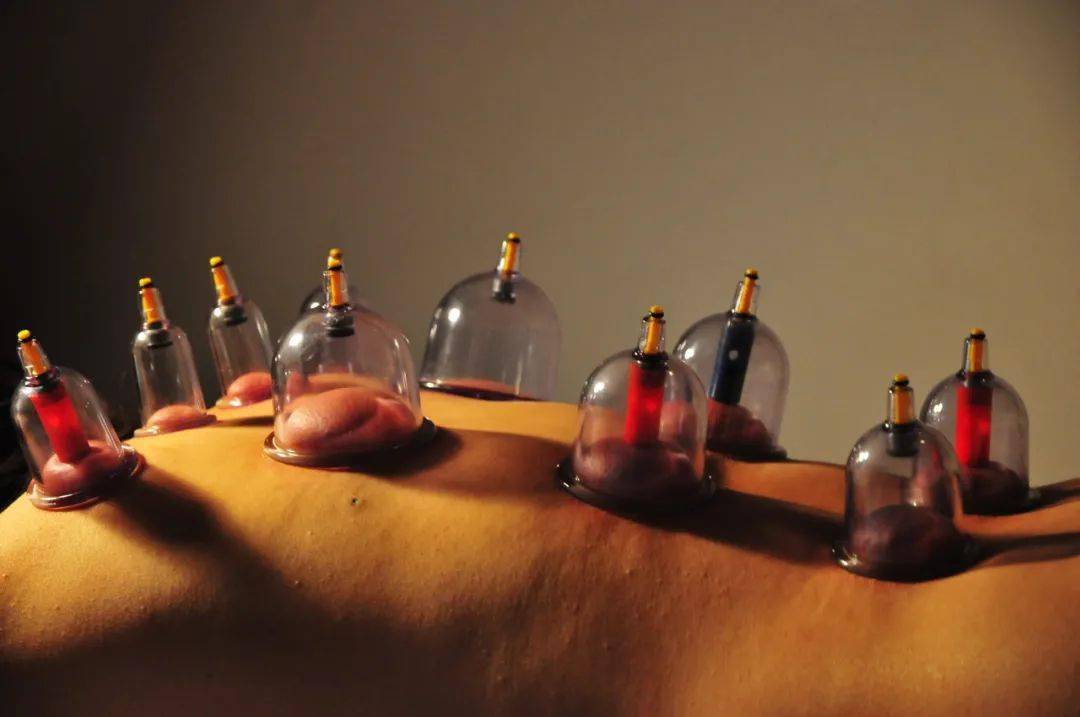 拔罐为什么有的紫有的红 6c1d1f950ddd45f0a446da3607cd7f29.jpeg