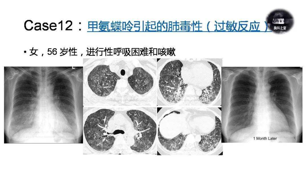 过敏性肺炎的影像学表现