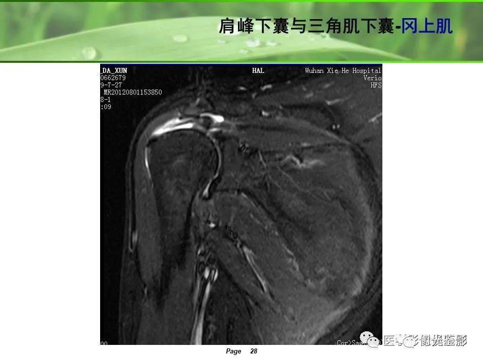 肩關節mri解剖肩袖損傷診斷技巧