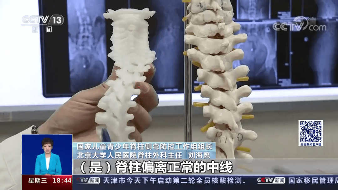 青少年|中小学生脊柱侧弯人数已超500万!这些不良习惯速改