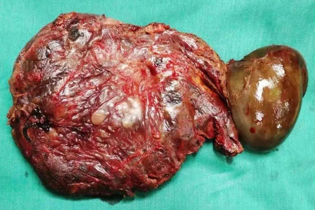 巨大肝血管瘤图片