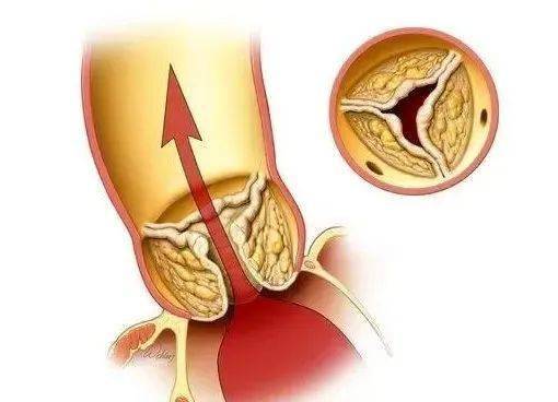 瓣膜|一次手术解决心脏五个问题！河西院区好样的！