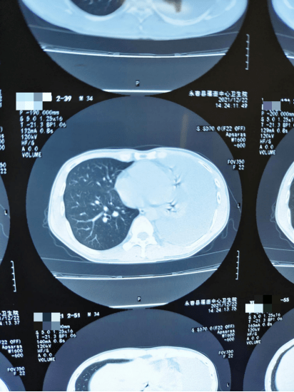 术前术后病理结果结合病史,影像学,结核感染t细胞检测,结核性胸膜炎可