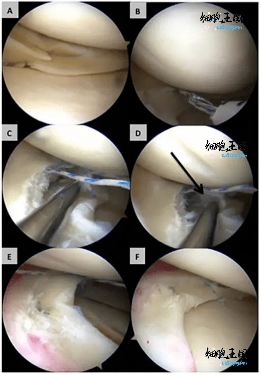 干细胞修复半月板或让闪电侠韦德免去摘除之苦