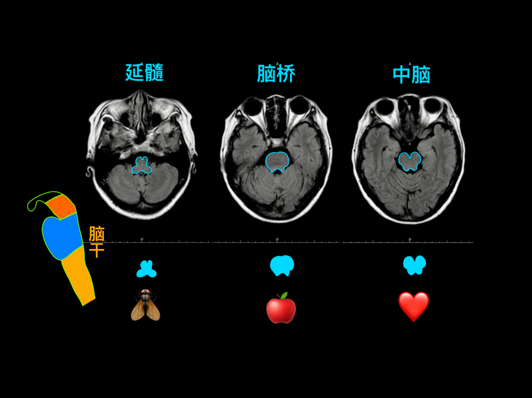 海马脑叶,基底节区额下回,颞横回,broca 区,wernicke 区l征,t 征,Ω
