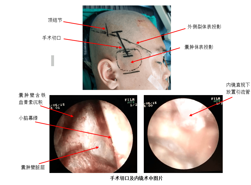 蛛网膜囊肿合并硬膜下血肿 微创手术解决双重病痛_患者_头部_外伤